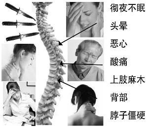 颈椎病症状结构图