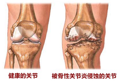 骨性关节炎,骨关节炎,关节炎