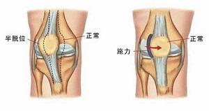 膝关节半月板损伤有哪些症状