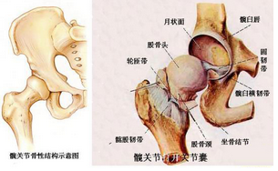 股骨头坏死示意图